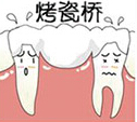 烤瓷桥