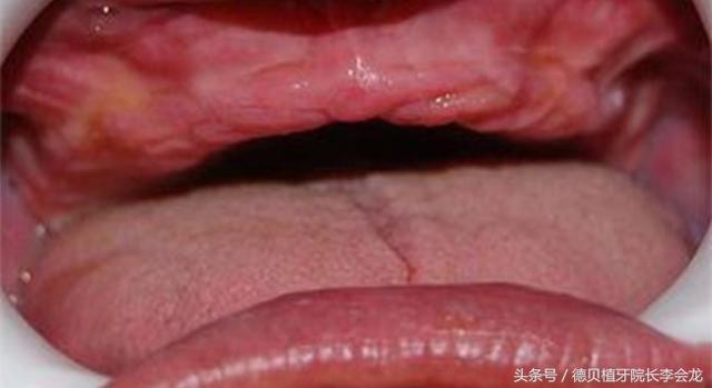 活动假牙究竟可以戴多久?