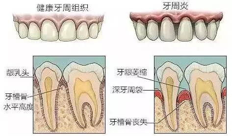 牙龈出血