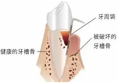 牙龈出血