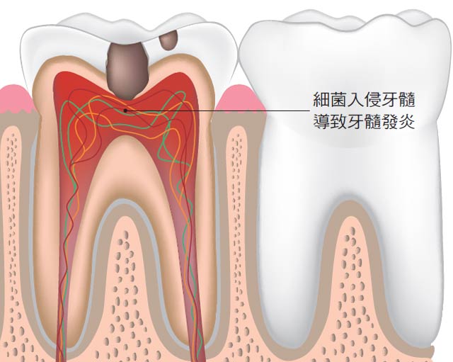 牙髓炎