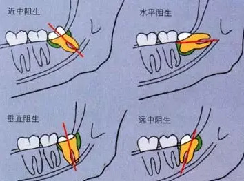 智齿