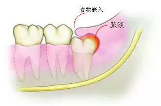 智齿